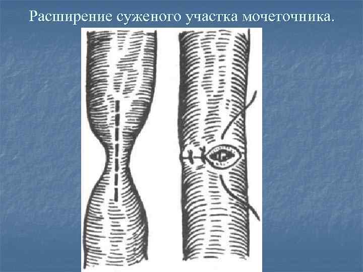 Расширение суженого участка мочеточника. 