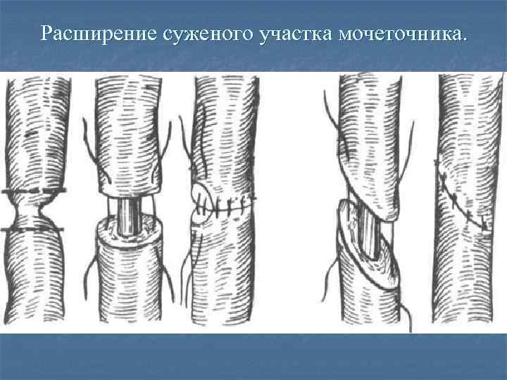 Расширение суженого участка мочеточника. 