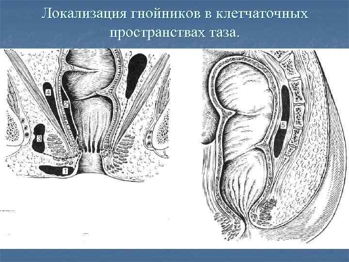 Локализация гнойников в клетчаточных пространствах таза. 
