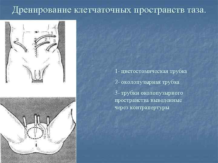 Дренирование клетчаточных пространств таза. 1 - цистостомическая трубка 2 - околопузырная трубка 3 -