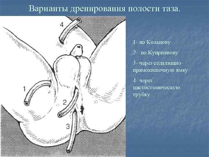 Варианты дренирования полости таза. 1 - по Кольцову 2 - по Куприянову 3 -