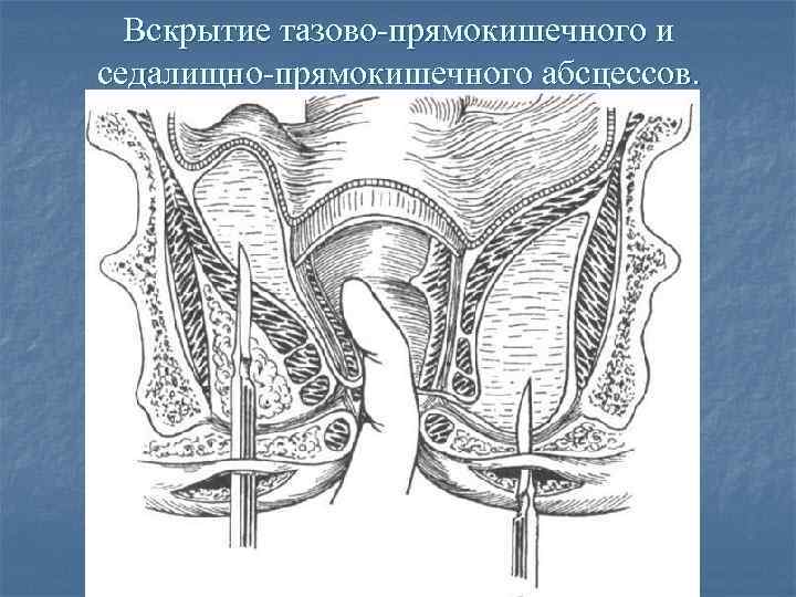 Сагиттальный и поперечный распил забрюшинного пространства схема