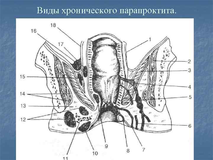 Парапроктит. Чрессфинктерный парапроктит. Хронический парапроктит интрасфинктерный. Острый и хронический парапроктит.