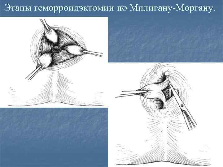 Этапы геморроидэктомии по Милигану-Моргану. 