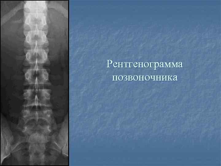 Рентгенограмма позвоночника 