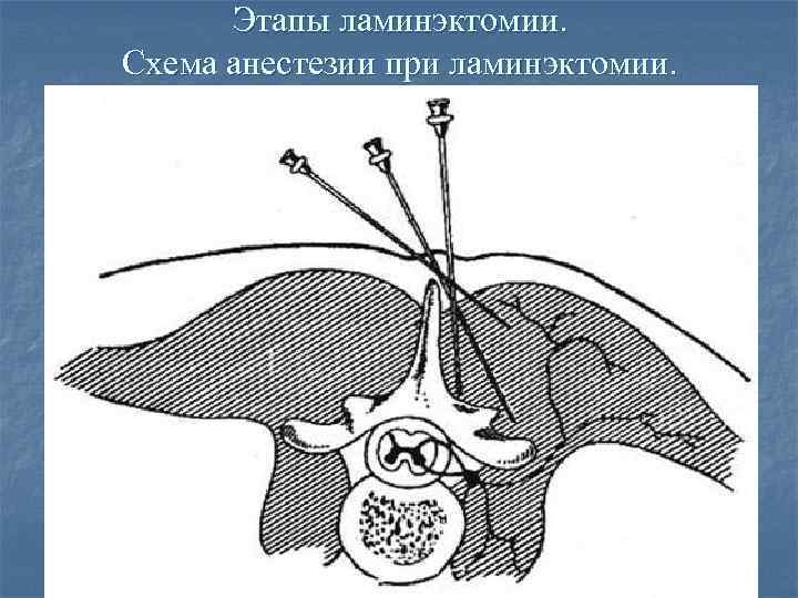 Этапы ламинэктомии. Схема анестезии при ламинэктомии. 
