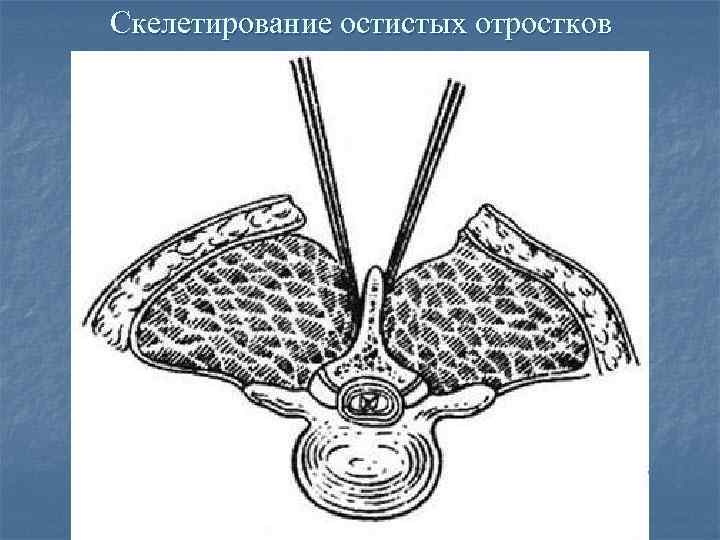 Скелетирование остистых отростков 