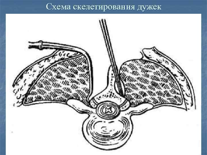 Схема скелетирования дужек 