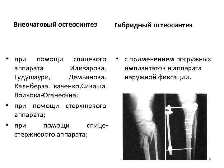Внеочаговый остеосинтез Гибридный остеосинтез • при помощи спицевого • с применением погружных аппарата Илизарова,