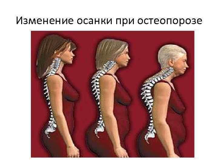 Изменение осанки при остеопорозе 