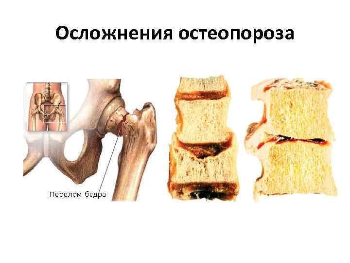 Осложнения остеопороза 