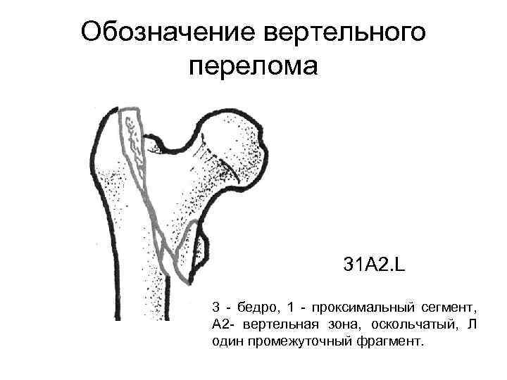 Обозначение вертельного перелома 31 А 2. L 3 - бедро, 1 - проксимальный сегмент,