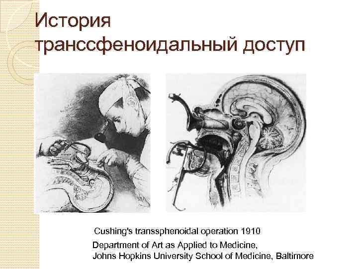 История транссфеноидальный доступ Cushing's transsphenoidal operation 1910 Department of Art as Applied to Medicine,