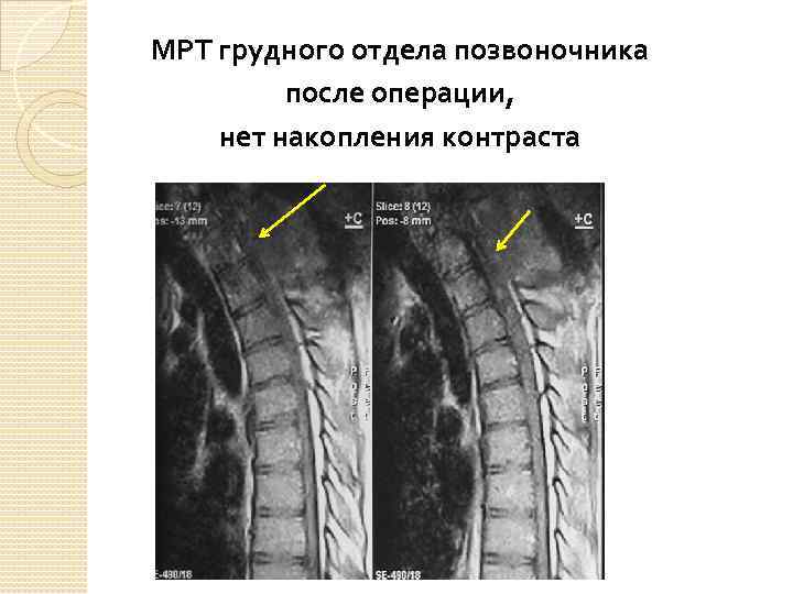 После контраста. Описание мрт грудного отдела позвоночника. Грудной отдел позвоночника с контрастом. Почки на мрт грудного отдела позвоночника. Моделирование позвоночника по результатам кт без контраста.