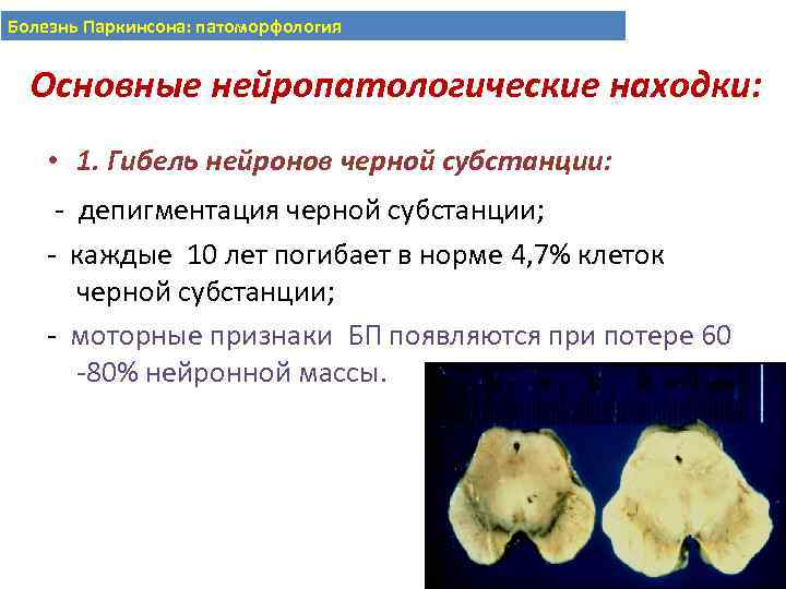 Болезнь Паркинсона: патоморфология Основные нейропатологические находки: • 1. Гибель нейронов черной субстанции: - депигментация