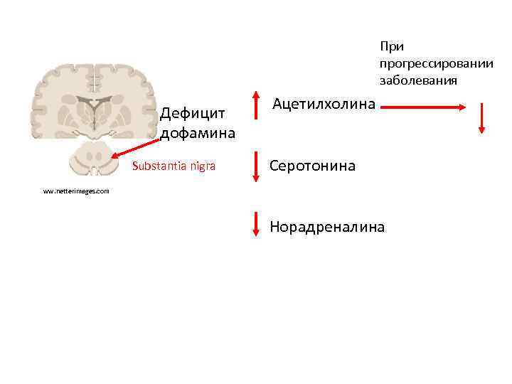 Патогенез болезни паркинсона схема