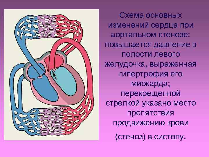 Схема основных изменений сердца при аортальном стенозе: повышается давление в полости левого желудочка, выраженная