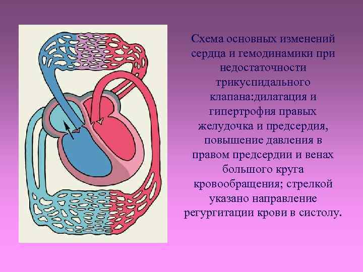 Схема основных изменений сердца и гемодинамики при недостаточности трикуспидального клапана: дилатация и гипертрофия правых