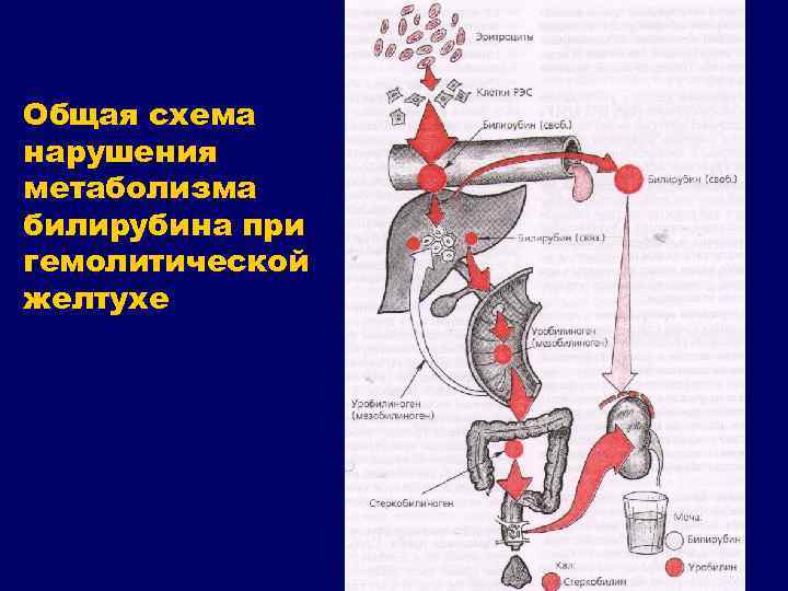 Общая схема нарушения метаболизма билирубина при гемолитической желтухе 