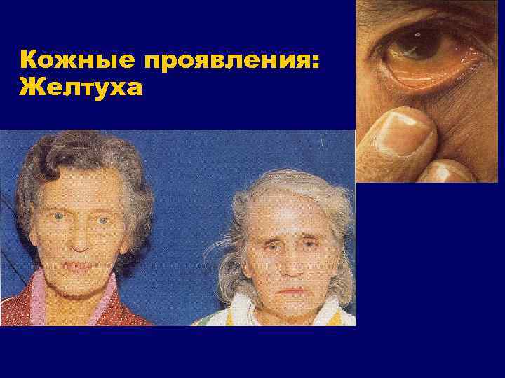 Кожные проявления: Желтуха 