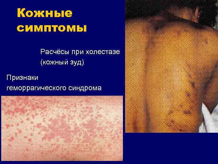Кожные симптомы Расчёсы при холестазе (кожный зуд) Признаки геморрагического синдрома 