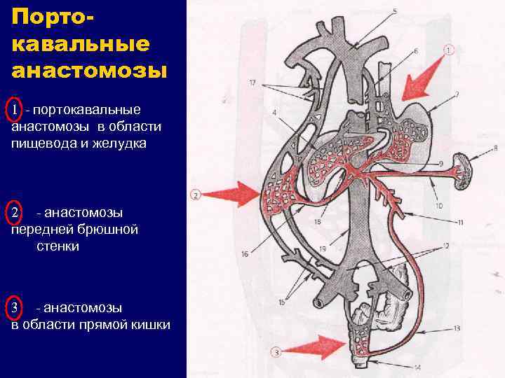 Портокавальные анастомозы 1 - портокавальные анастомозы в области пищевода и желудка 2 - анастомозы