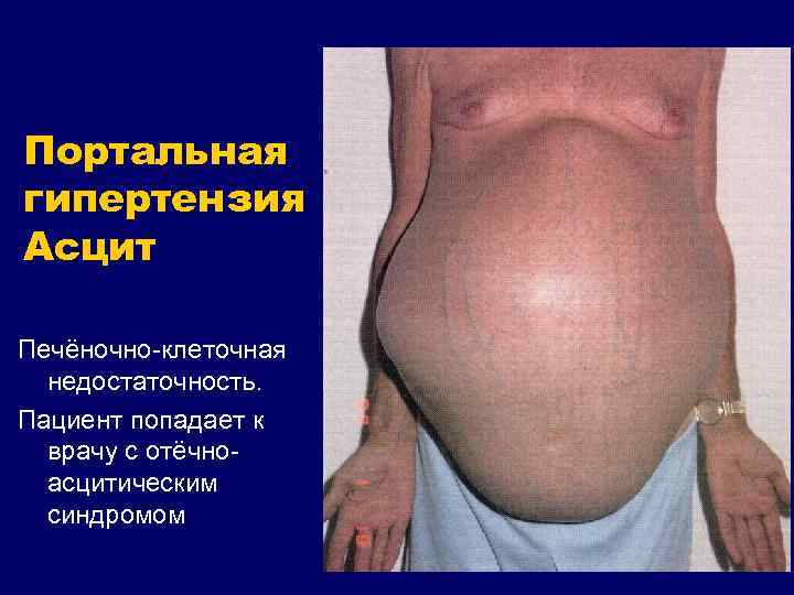 Портальная гипертензия Асцит Печёночно-клеточная недостаточность. Пациент попадает к врачу с отёчноасцитическим синдромом 