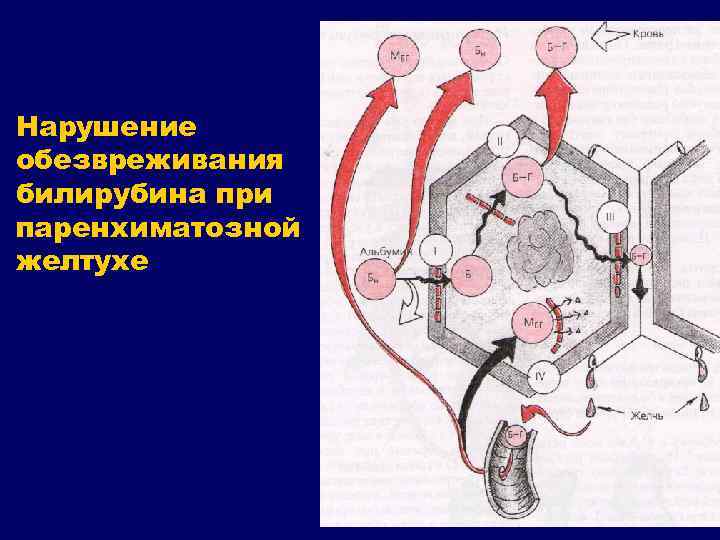 Нарушение обезвреживания билирубина при паренхиматозной желтухе 