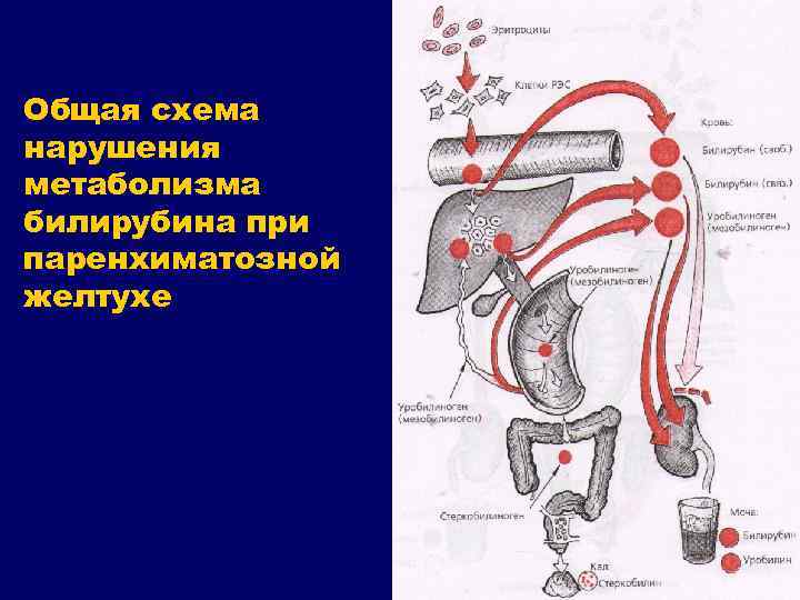 Общая схема нарушения метаболизма билирубина при паренхиматозной желтухе 