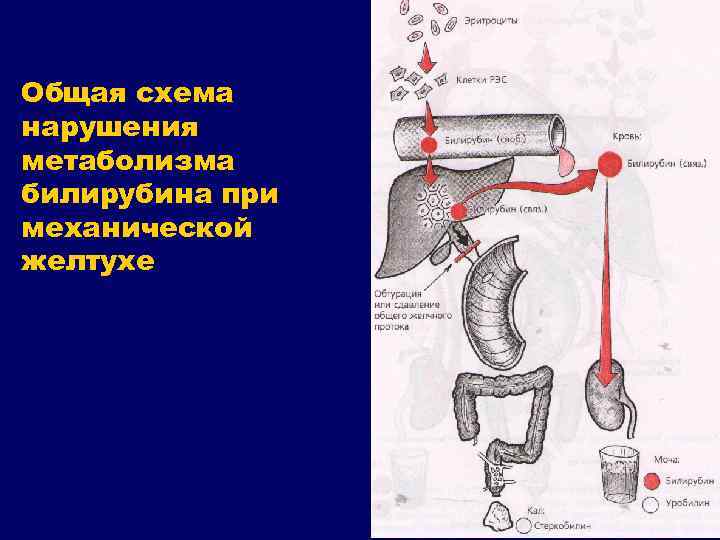 Общая схема нарушения метаболизма билирубина при механической желтухе 