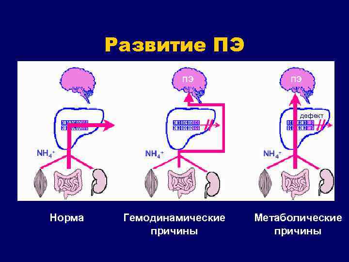 Развитие ПЭ ПЭ ПЭ дефект Норма Гемодинамические причины Метаболические причины 