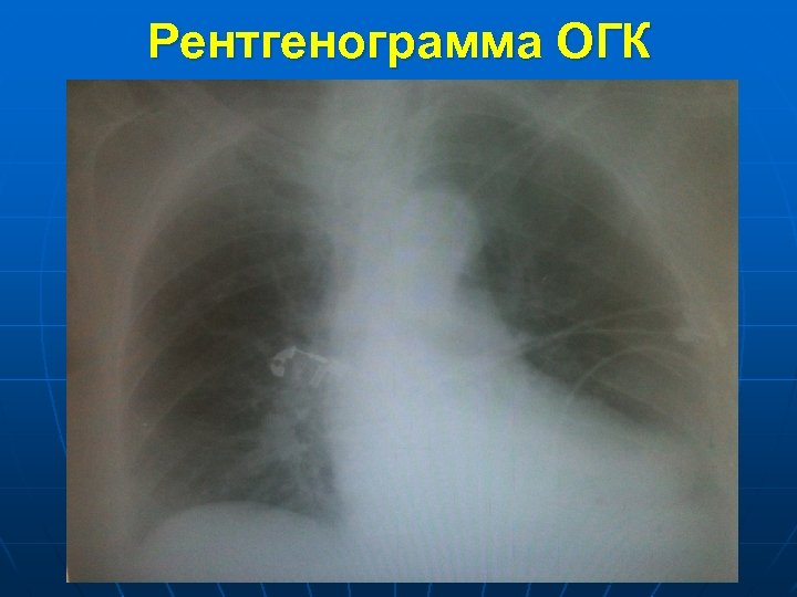 Рентгенограмма ОГК 