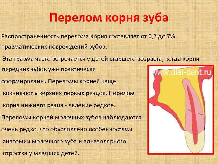 Перелом корня зуба Распространенность перелома корня составляет от 0, 2 до 7% травматических повреждений