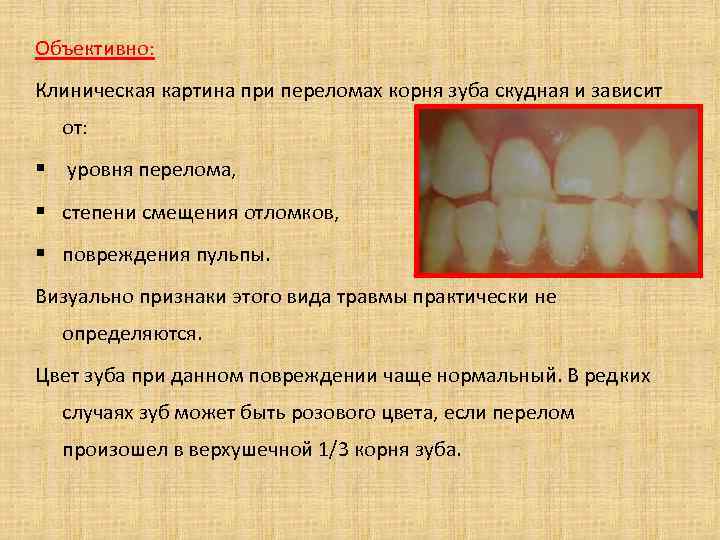 Объективно: Клиническая картина при переломах корня зуба скудная и зависит от: § уровня перелома,