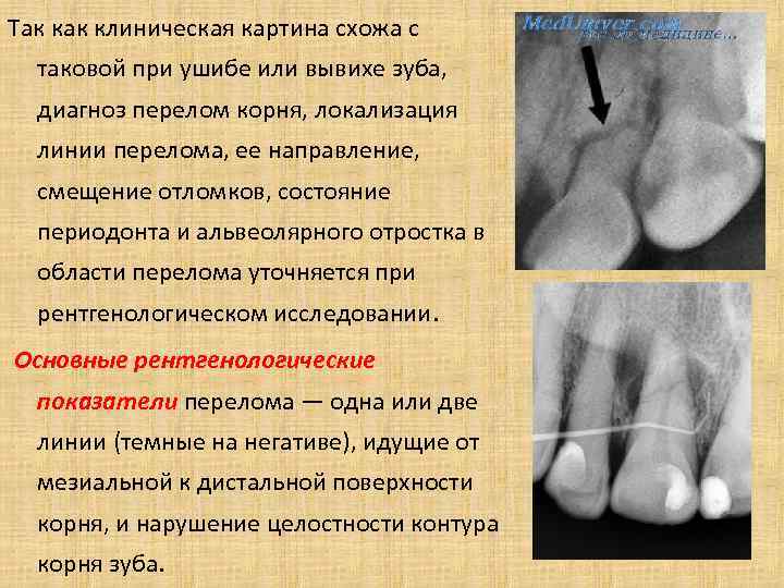 Так клиническая картина схожа с таковой при ушибе или вывихе зуба, диагноз перелом корня,