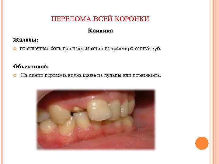 ПЕРЕЛОМА ВСЕЙ КОРОНКИ Клиника Жалобы: повышенная боль при накусывании на травмированный зуб. Объективно: На