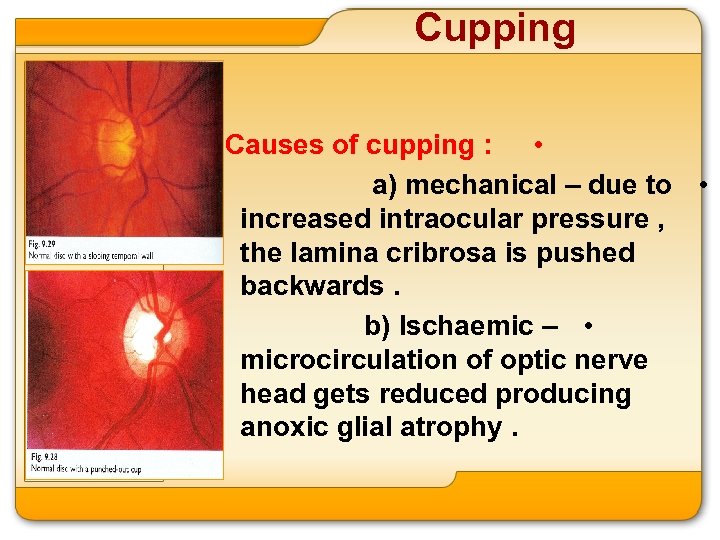 Cupping Causes of cupping : • a) mechanical – due to • increased intraocular
