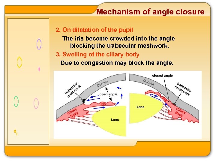 Mechanism of angle closure 2. On dilatation of the pupil The iris become crowded