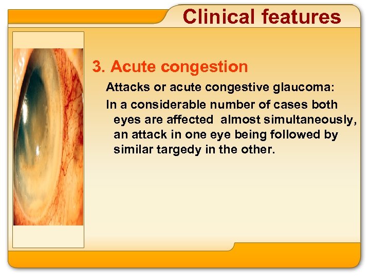 Clinical features 3. Acute congestion Attacks or acute congestive glaucoma: In a considerable number