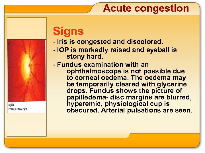 Acute congestion Signs - Iris is congested and discolored. - IOP is markedly raised