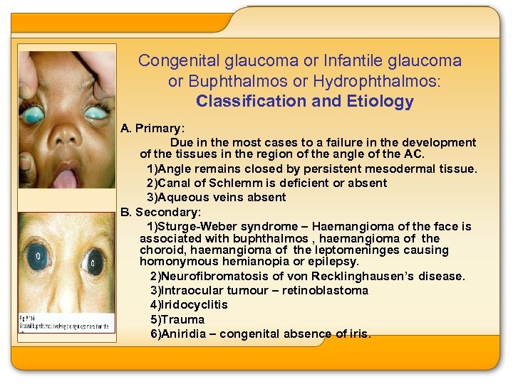 Congenital glaucoma or Infantile glaucoma or Buphthalmos or Hydrophthalmos: Classification and Etiology A. Primary: