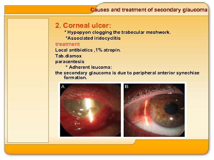 Causes and treatment of secondary glaucoma 2. Corneal ulcer: * Hypopyon clogging the trabecular