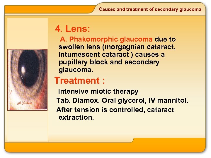 Causes and treatment of secondary glaucoma 4. Lens: A. Phakomorphic glaucoma due to swollen