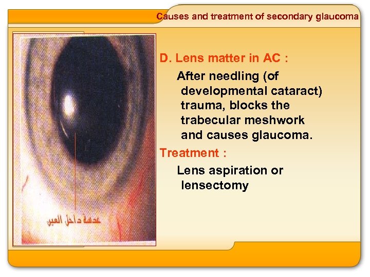 Causes and treatment of secondary glaucoma D. Lens matter in AC : After needling