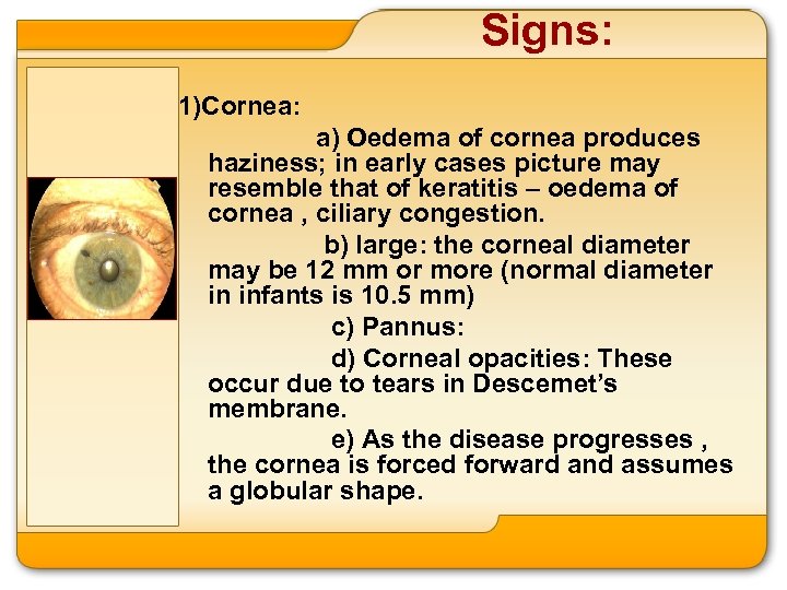 Signs: 1)Cornea: a) Oedema of cornea produces haziness; in early cases picture may resemble