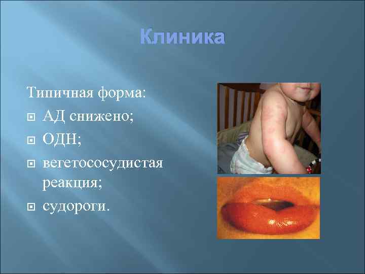 Клиника Типичная форма: АД снижено; ОДН; вегетососудистая реакция; судороги. 