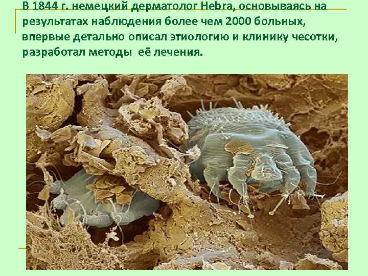 В 1844 г. немецкий дерматолог Hebra, основываясь на результатах наблюдения более чем 2000 больных,