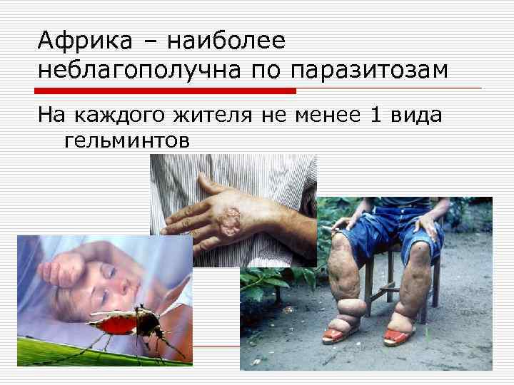 Африка – наиболее неблагополучна по паразитозам На каждого жителя не менее 1 вида гельминтов