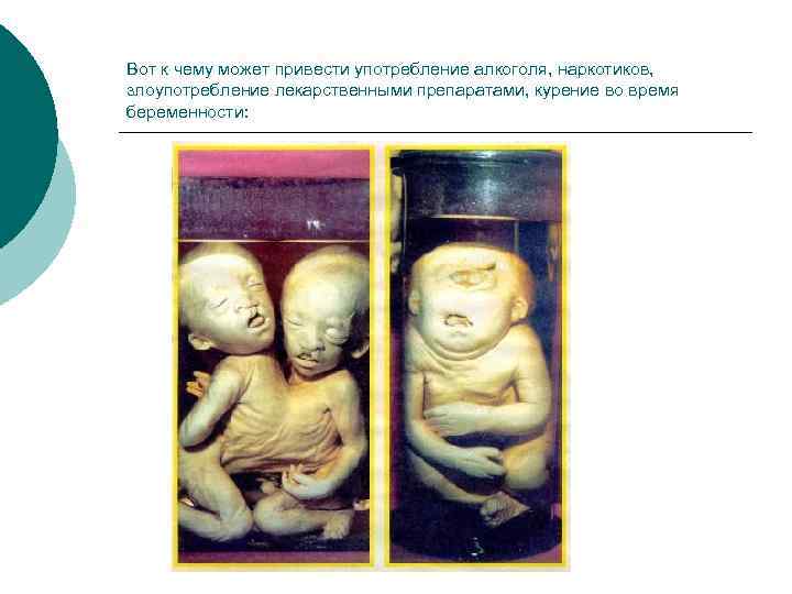 Вот к чему может привести употребление алкоголя, наркотиков, злоупотребление лекарственными препаратами, курение во время