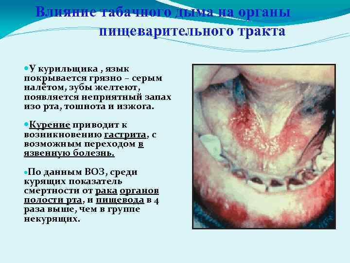 Влияние табачного дыма на органы пищеварительного тракта У курильщика , язык покрывается грязно –